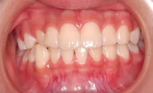 犬歯がずれている・噛み合わない・11歳女児【M.N様】