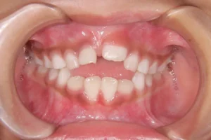 開咬・出っ歯・6歳女児【Y.A様】