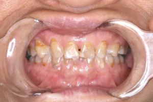 歯が足りない・ガタガタ・60歳女性【H.M】