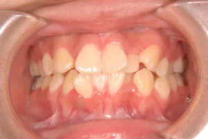 前歯がガタガタ・奥歯が傾いている・15歳女性【S.M様】