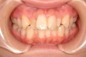 ガタガタ・90度ねじれている・22歳女性【A.O様】