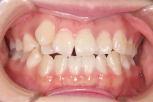 前歯のがたがた・真ん中のズレ・18歳女性【Y.U様】