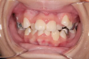 重度叢生・16歳女性【N.N様】