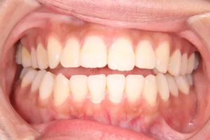 前歯で物が噛みちぎれない・滑舌が悪い・出っ歯・19歳女性【N.T様】