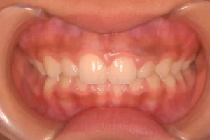 出っ歯・ガミー・過蓋咬合・10歳女性