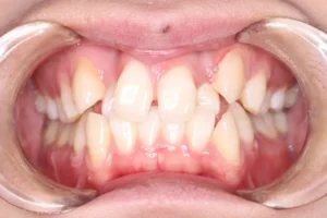 ガタガタ・八重歯・非抜歯症例・19歳女性【R.T様】