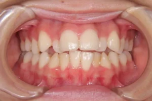 【大人の矯正】叢生・口ゴボの非抜歯症例・17歳女性【A.O様】