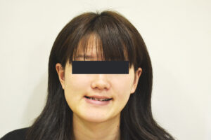 【大人の矯正】顎変形症・受け口・顎のゆがみ・噛めない・20歳女性【M.N様】