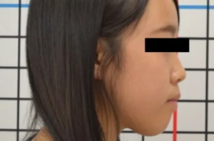 【大人の矯正】叢生・受け口・口ゴボ・開咬・非抜歯症例・17歳女性【A.O様】