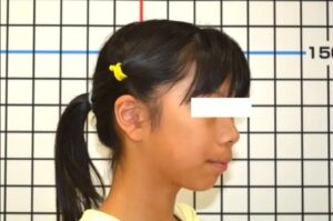【子供の矯正】出っ歯・ガミースマイル・過蓋咬合・非抜歯症例・10歳女性【T.K様】