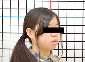 【大人の矯正】叢生・口ゴボ・口元が出ている・非抜歯症例・15歳女性【M.S様】