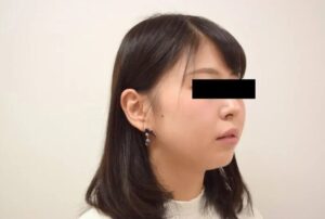 【大人の矯正】叢生・口ゴボ・上下がガタガタ・出っ歯・非抜歯症例・20歳女性【N.K様】