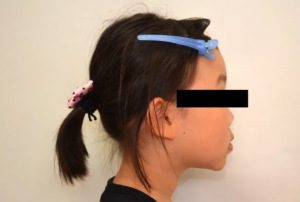 【子供の矯正（一期）】叢生・反対咬合・受け口・非抜歯症例・7歳女児【M.H様】