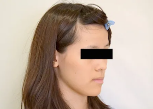 【大人の矯正】顎変形症・交叉咬合・切端咬合・受け口・顎のゆがみ・18歳女性【Y.F様】