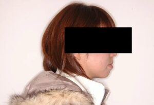 【大人の矯正】受け口・八重歯・叢生・非抜歯症例・33歳女性【M.Y様】