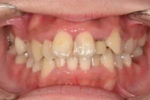 【大人の矯正】ガタガタ・口ゴボ・ガミースマイル・非抜歯症例・21歳女性【N.A様】