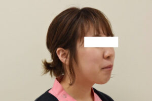 【大人の矯正】出っ歯・叢生・口ゴボ・ガミースマイル・非抜歯症例・21歳女性【N.A様】