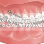 アンカースクリュー矯正のメリット・デメリット〜可能となる治療を専門医が解説